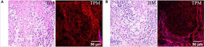 Assessment of Extramammary Paget Disease by Two-Photon Microscopy